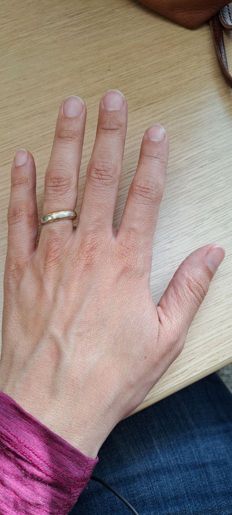 Photo of Bradlee's left hand